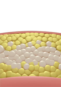 Abtransport der Fettzellen